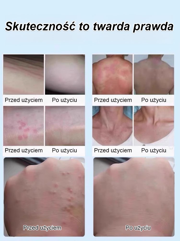 【Pogromca egzemy】Płynny opatrunek do pielęgnacji skóry