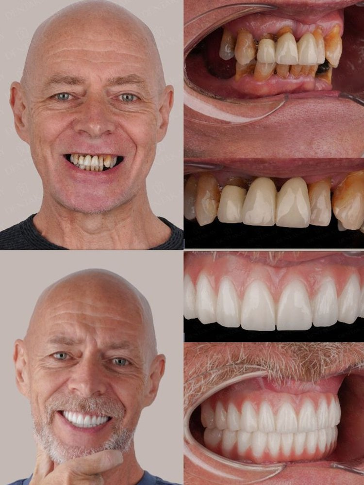 【Nowe odkrycie brytyjskich naukowców】Proteza zębowa z silikonu