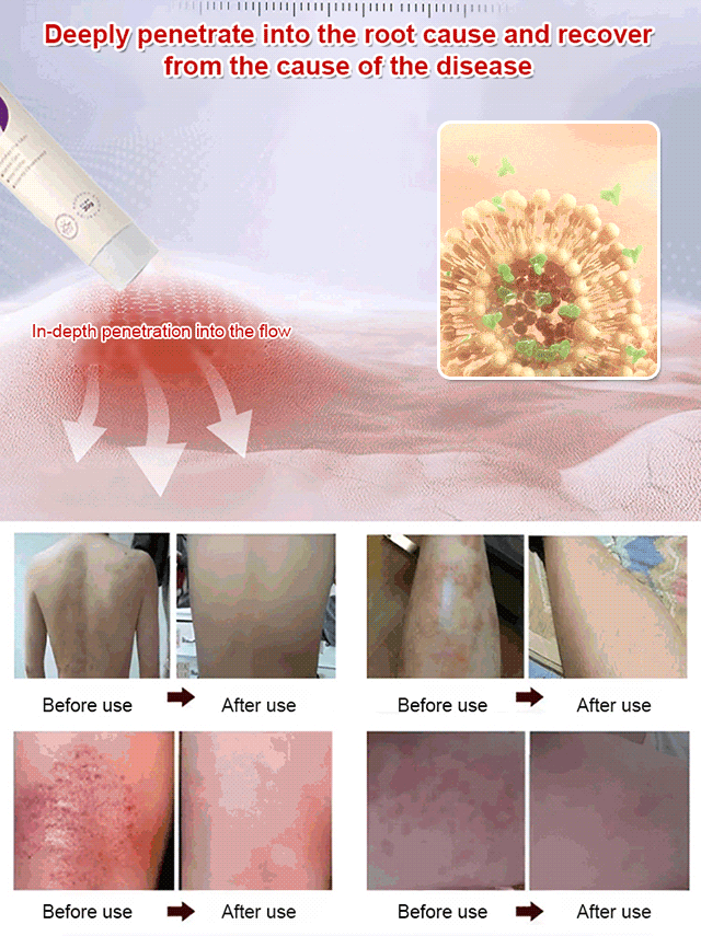 [Specializing in stubborn dermatitis] Skin soothing care cream