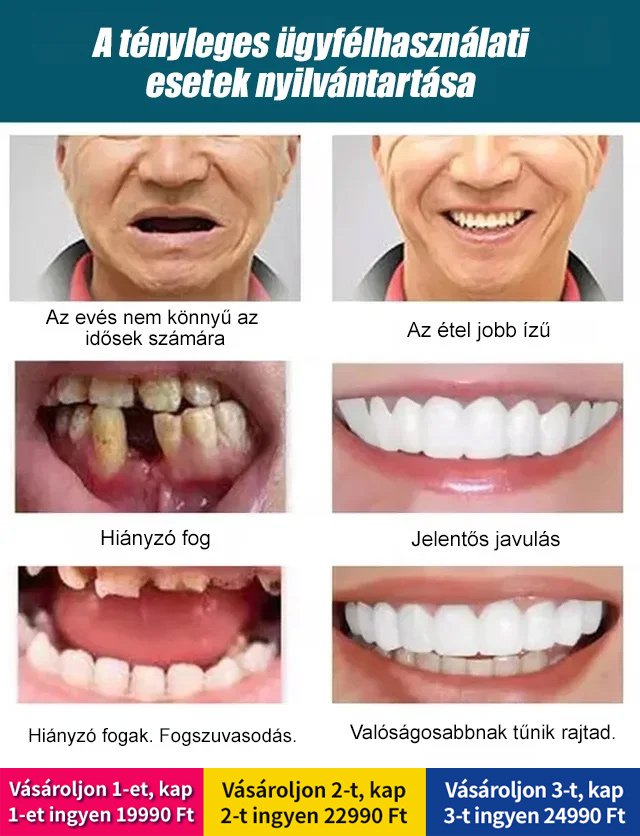 Állítható bepattintható műfogsor