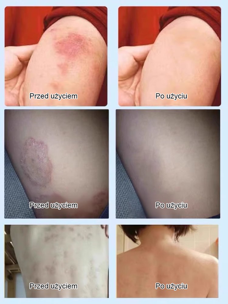 【Pogromca egzemy】Płynny opatrunek do pielęgnacji skóry