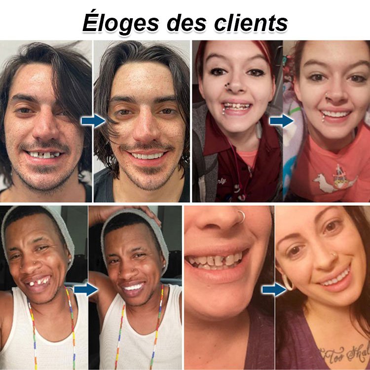 Prothèse dentaire ensemble de beauté dentaire