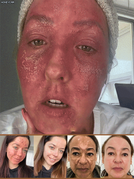 Crème lissante anti-cicatrice au venin d'abeille