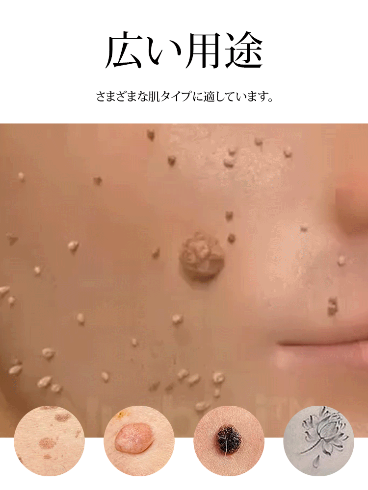 レーザーイボ取り美顔ペン