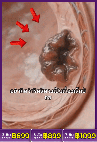 【ผลิตภัณฑ์ใหม่】ครีมรักษาริดสีดวงทวารภายใน ภายนอกและแบบผสม