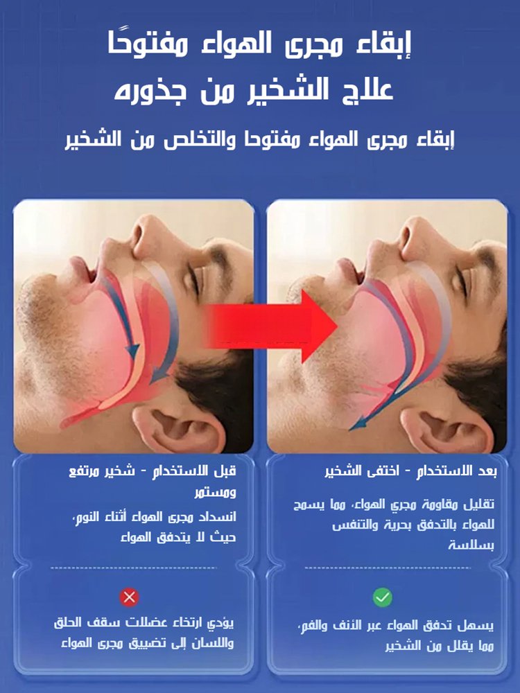 تقويم الأسنان قابل للتعديل لتحسين وعلاج الشخير【منقذ النوم】