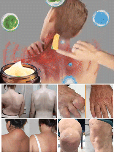 Bienengift schmerzlindernde Knochenheilungskreme