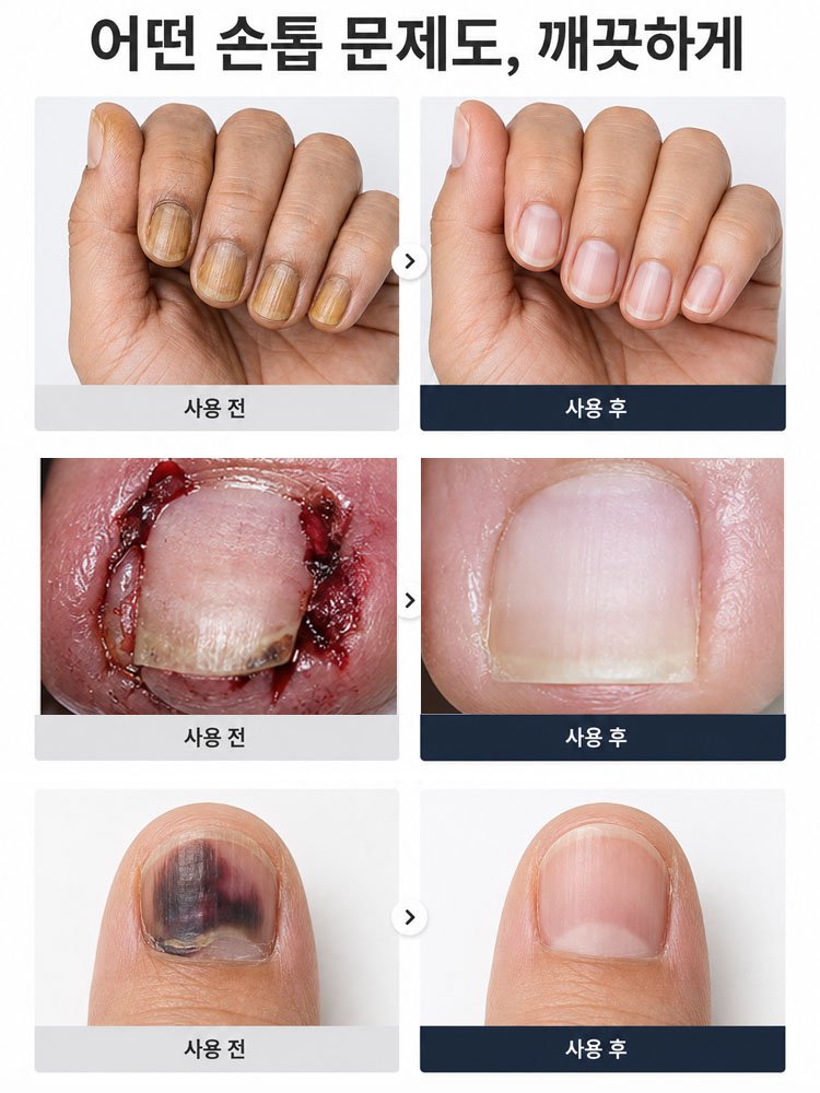【장마철 대비】내성 발톱 전용 네일 클리퍼