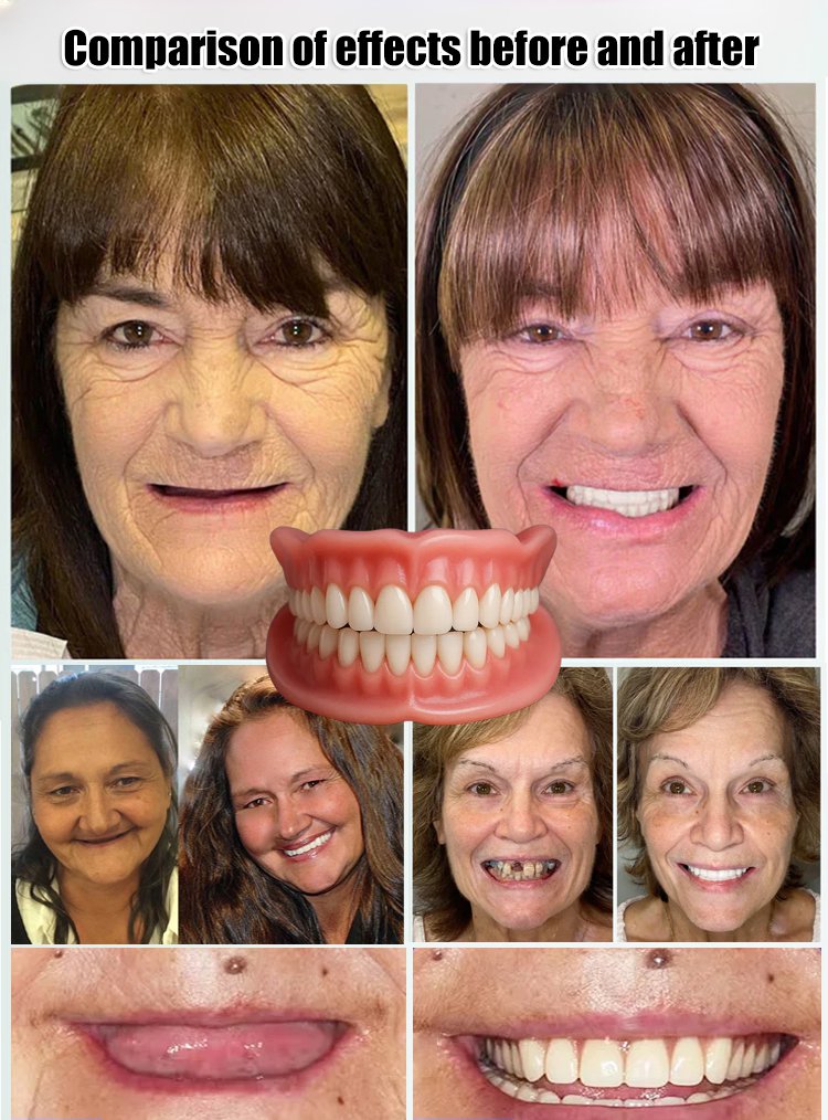 Comfortable Full Dentures with a Natural Fit