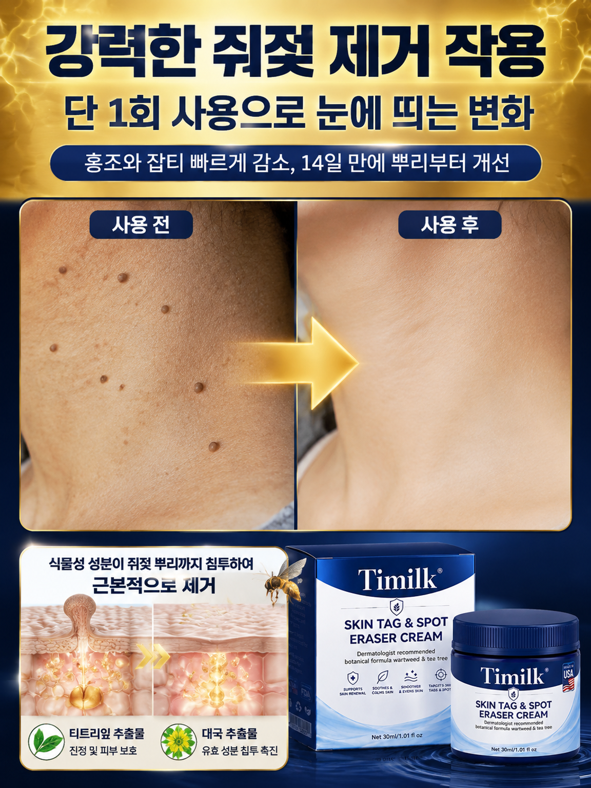 7일 피부 사마귀 제거 크림