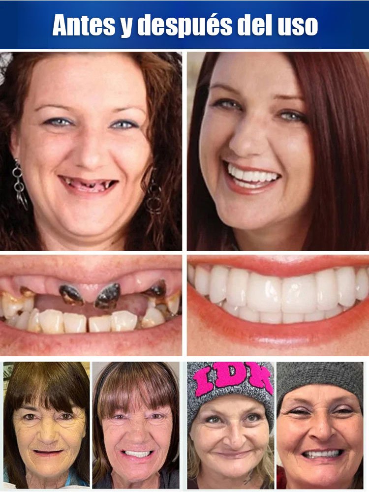 【Certificación FDA】Prótesis dentales personalizadas de ajuste perfecto