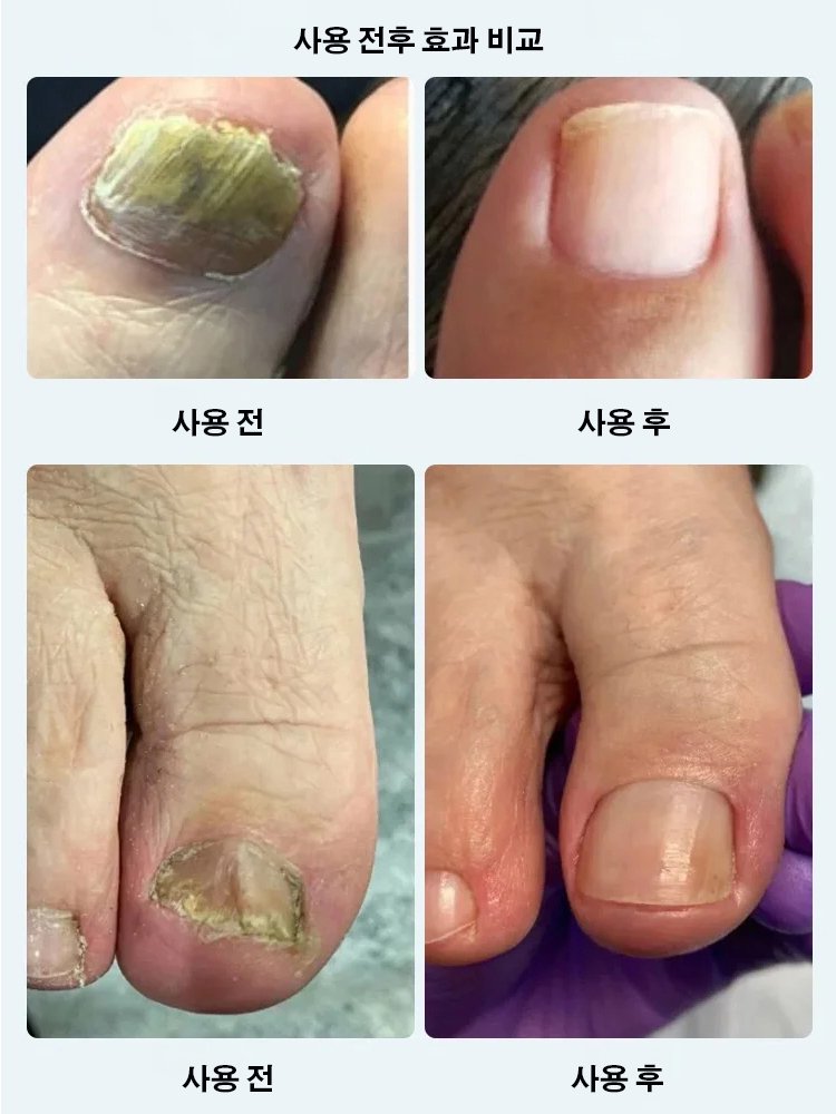 손발톱 무좀 곰팡이 관리 펜