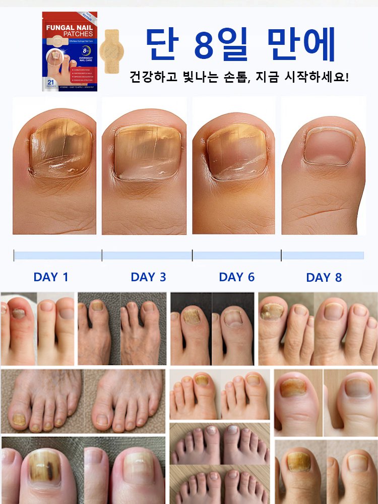 손톱 케어 교정 항균 패치