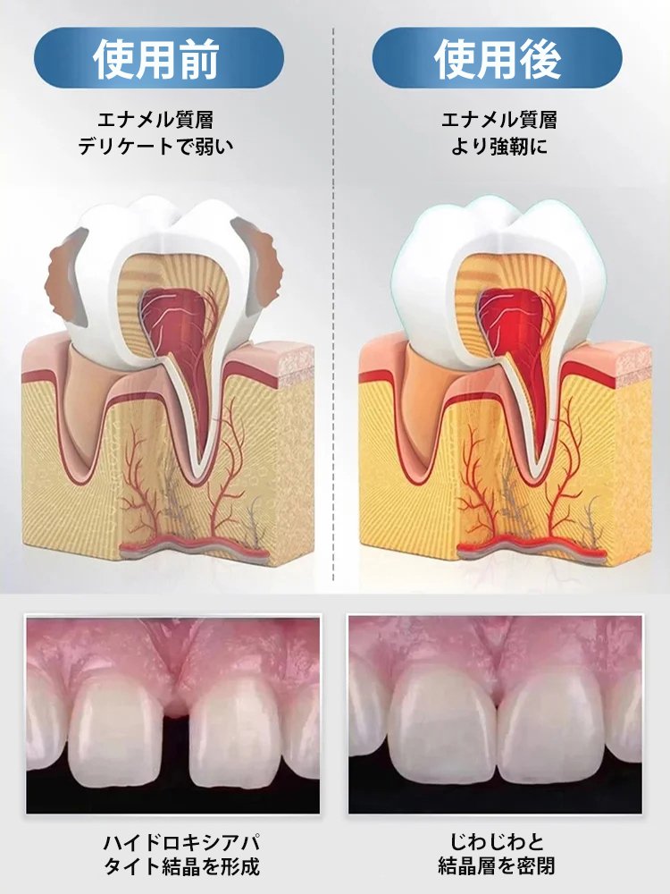【有名な歯科医推薦】ハイドロキシアパタイト歯用保護液
