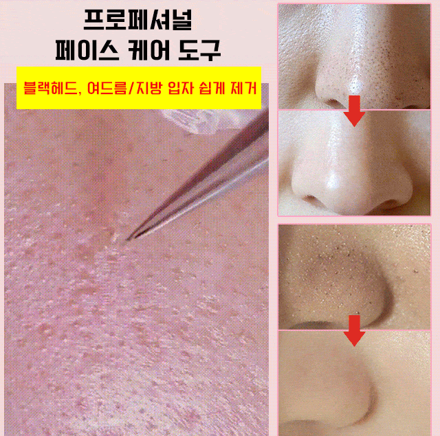 【최고 국립대병원 피부과 전문의 추천, 1초 만에 완고한 블랙헤드와 여드름을 깨끗하게 제거】의료용 SUS420 스테인리스초정밀 블랙헤드 제거 3종 세트