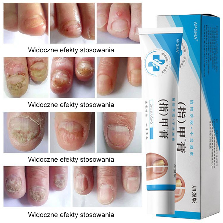 [Bezbolesne i bez nawrotów] Maść na grzybicę paznokci