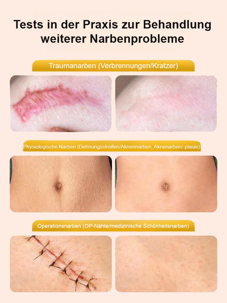 Bienengift Hautnarben glättende Creme