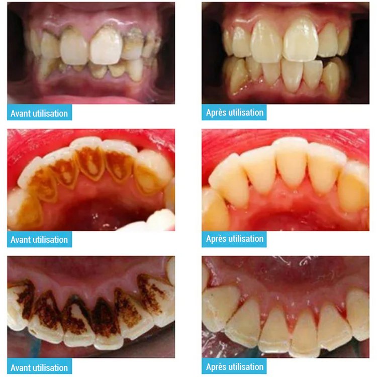 Appareil de nettoyage dentaire à ultrasons pour blanchiment des dents