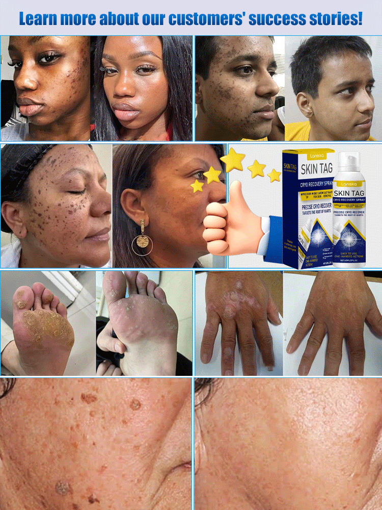 LANISKA Wart Care Topical Spray