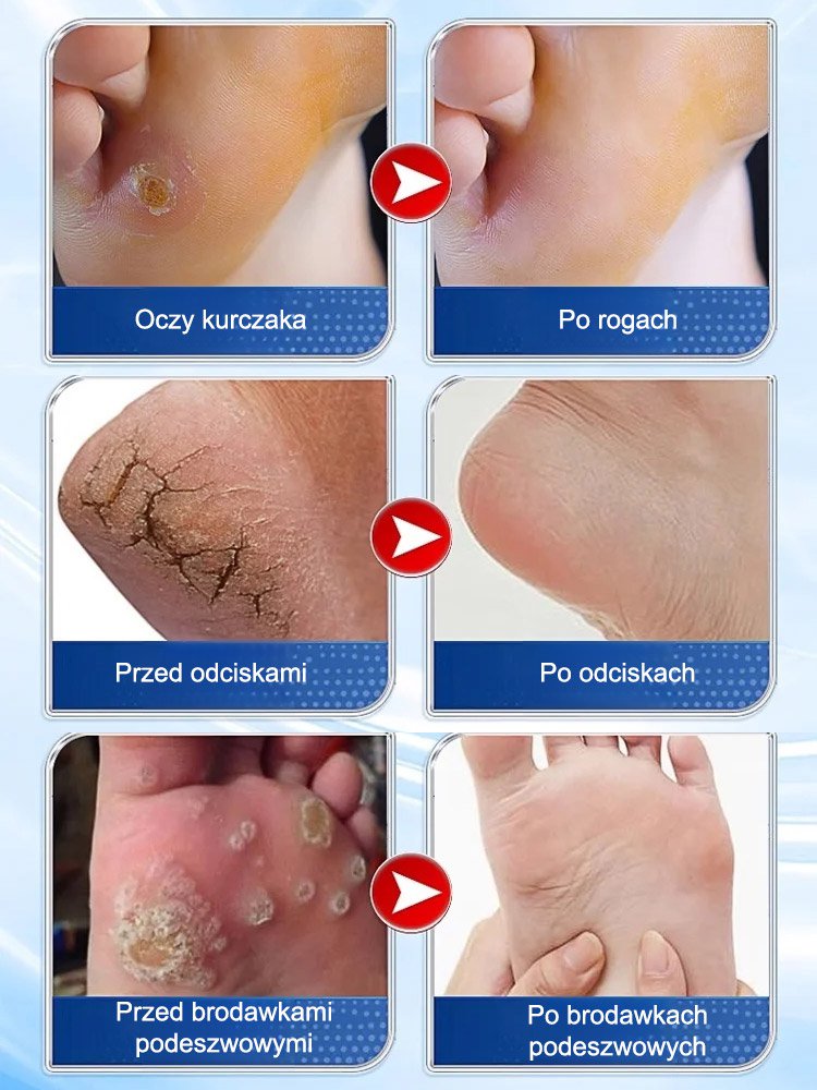 7-dniowy bezbolesny ziołowy krem do usuwania modzeli