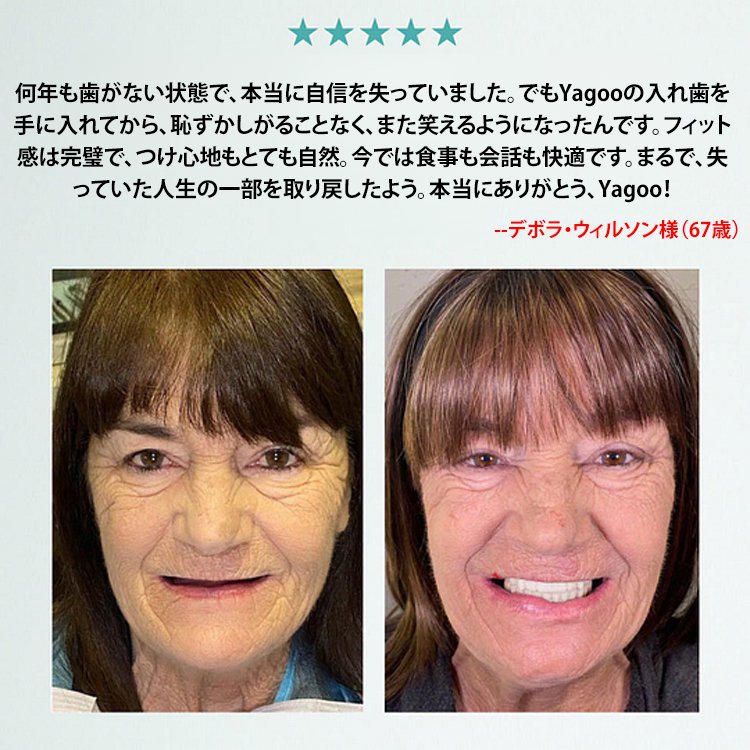 【オールインカスタムモデル】入れ歯セット