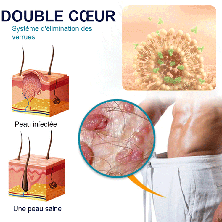 Crème pour l'élimination des verrues et l'adoucissement de la peau.