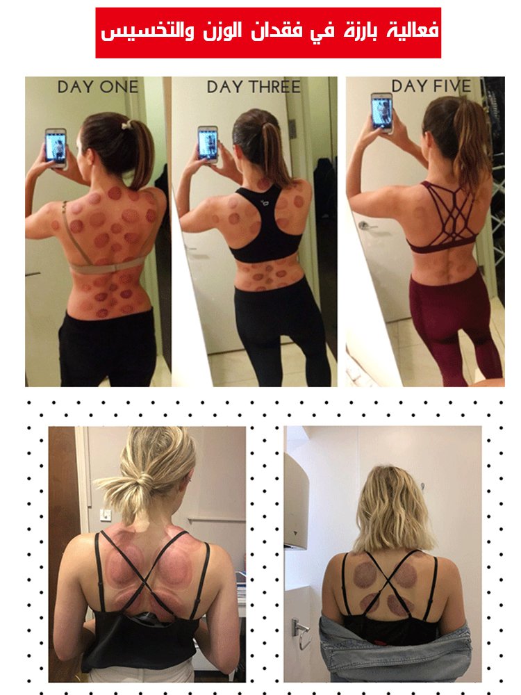 جهاز الحجامة بالفراغ المنزلي (مانع للحروق)