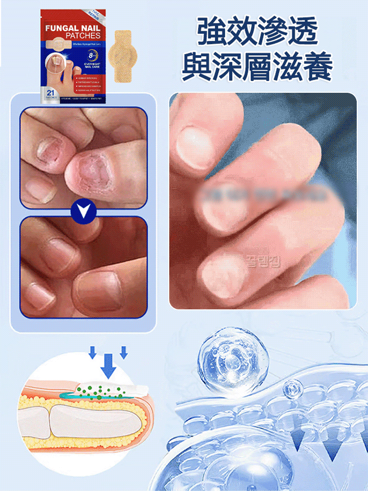 指甲修護矯正抑菌貼