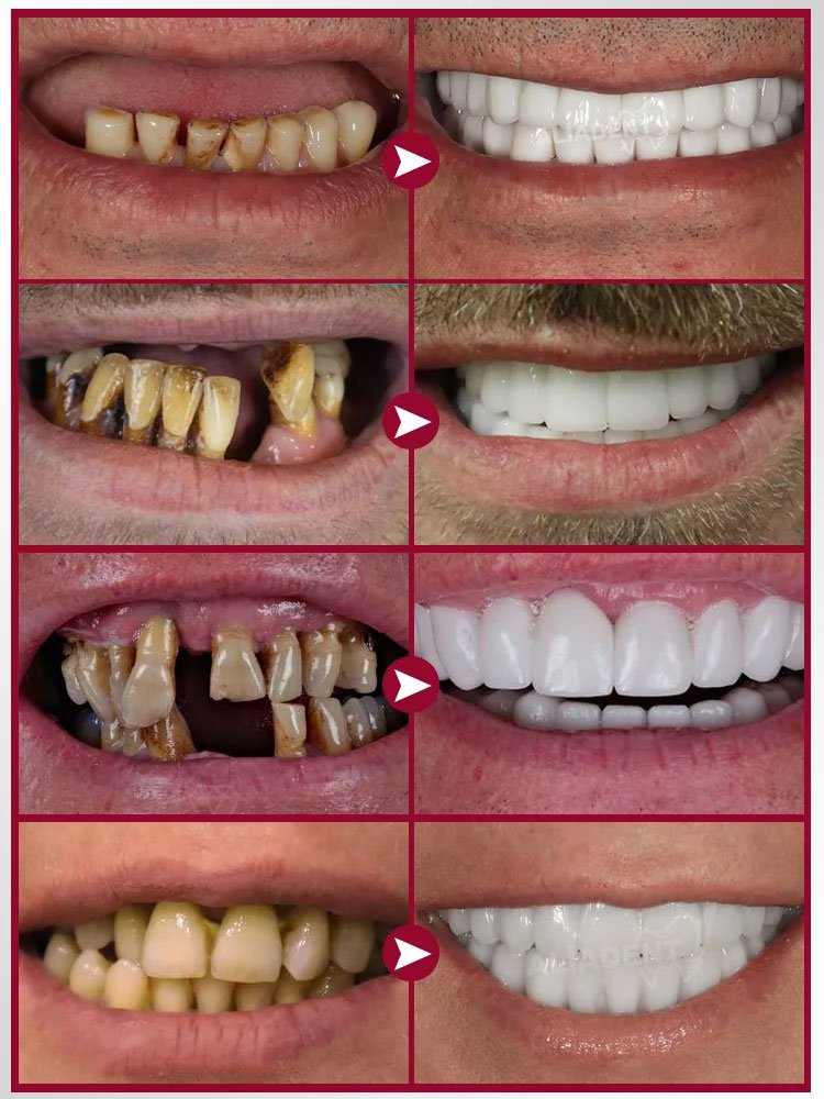 Oralhoe Zahnersatzfixierkleber