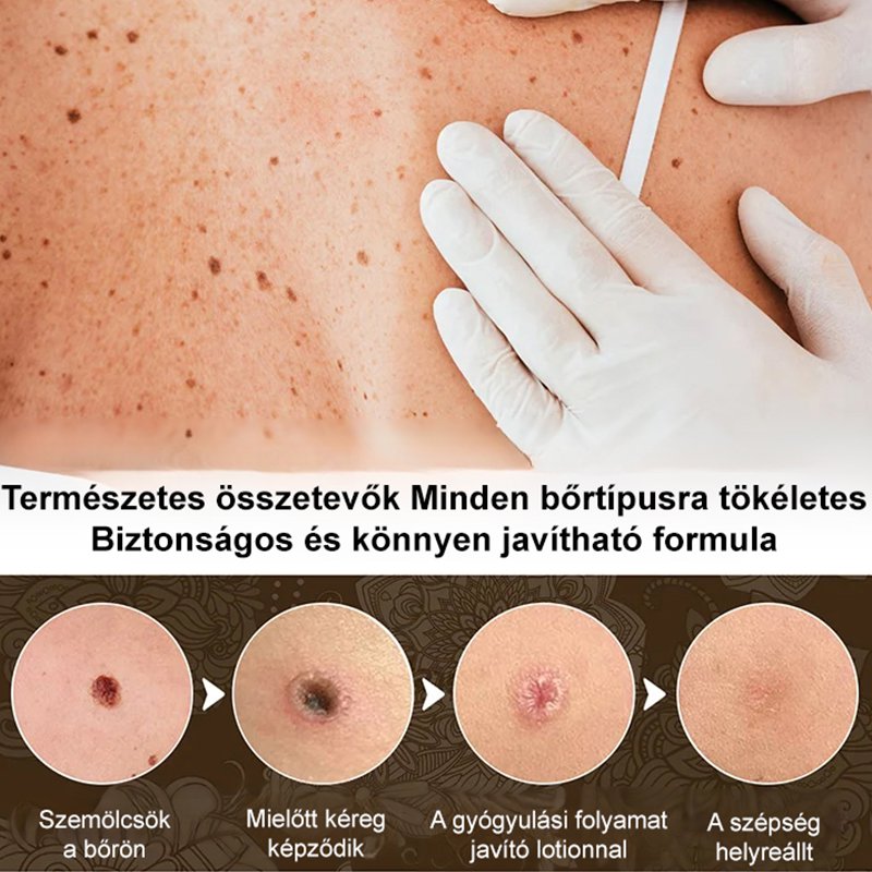 Eelhoe szemölcseltávolító kenőcs