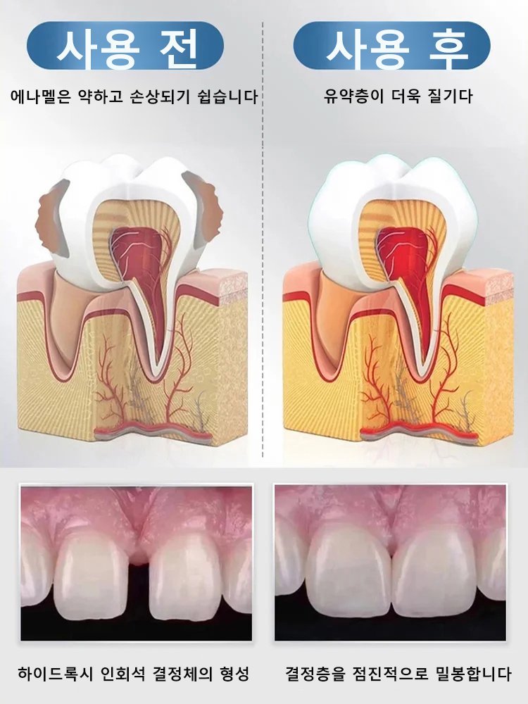 정상 국립대 개발 치아 회복액, 병원·시술 없이 하루 몇 방울로 충치 회복과 시린 이 완화!