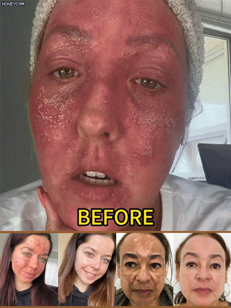 Bienengift Hautnarben glättende Creme