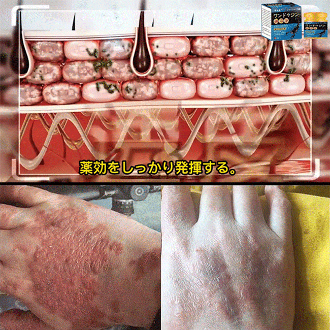 乾癬対策クリーム