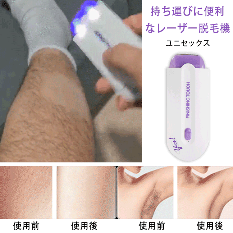 美容外科学会推薦！【男女兼用】スマート無痛脱毛機！脱毛・美肌・黒ずみケア